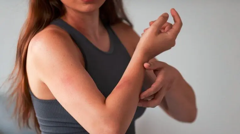 Consejos picaduras mosquitos - freepik