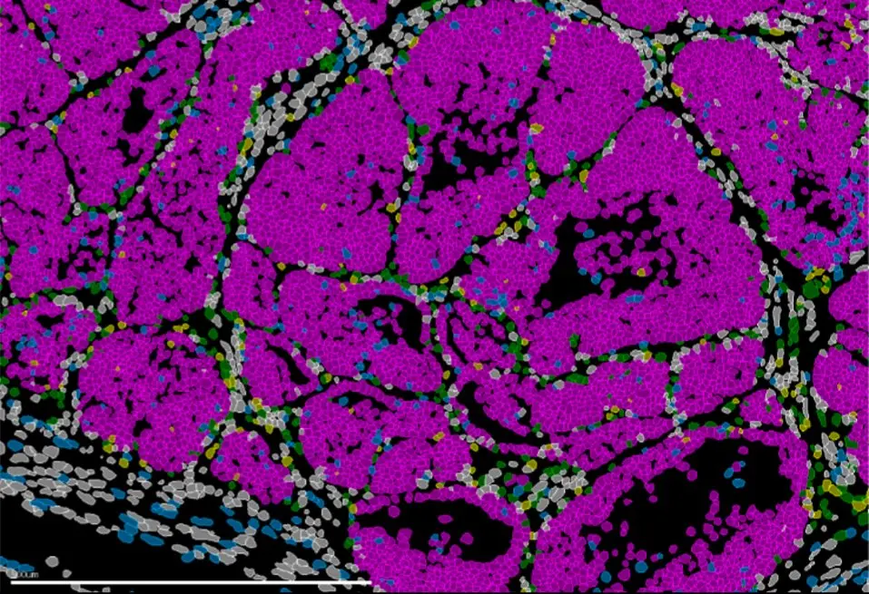 Tumor de mama en rat&oacute;n con c&eacute;lulas cancerosas (rosa). IN CSIC-UMH