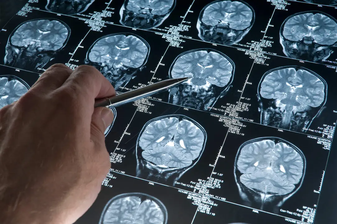 El diagn&oacute;stico de patolog&iacute;as degenerativas sigue bas&aacute;ndose en t&eacute;cnicas de hace m&aacute;s de 30 a&ntilde;os. / iStock