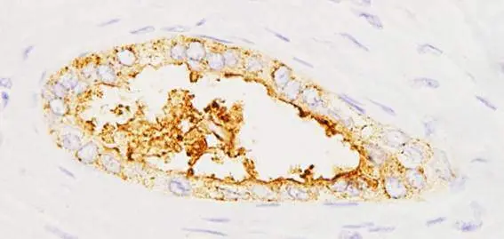 Expresi&oacute;n de la prote&iacute;na sAXL en tumores pancre&aacute;ticos. / IIBB-CSIC