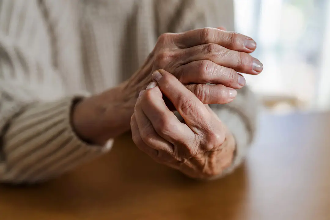 Manos de una persona con artritis reumatoide. / iStock