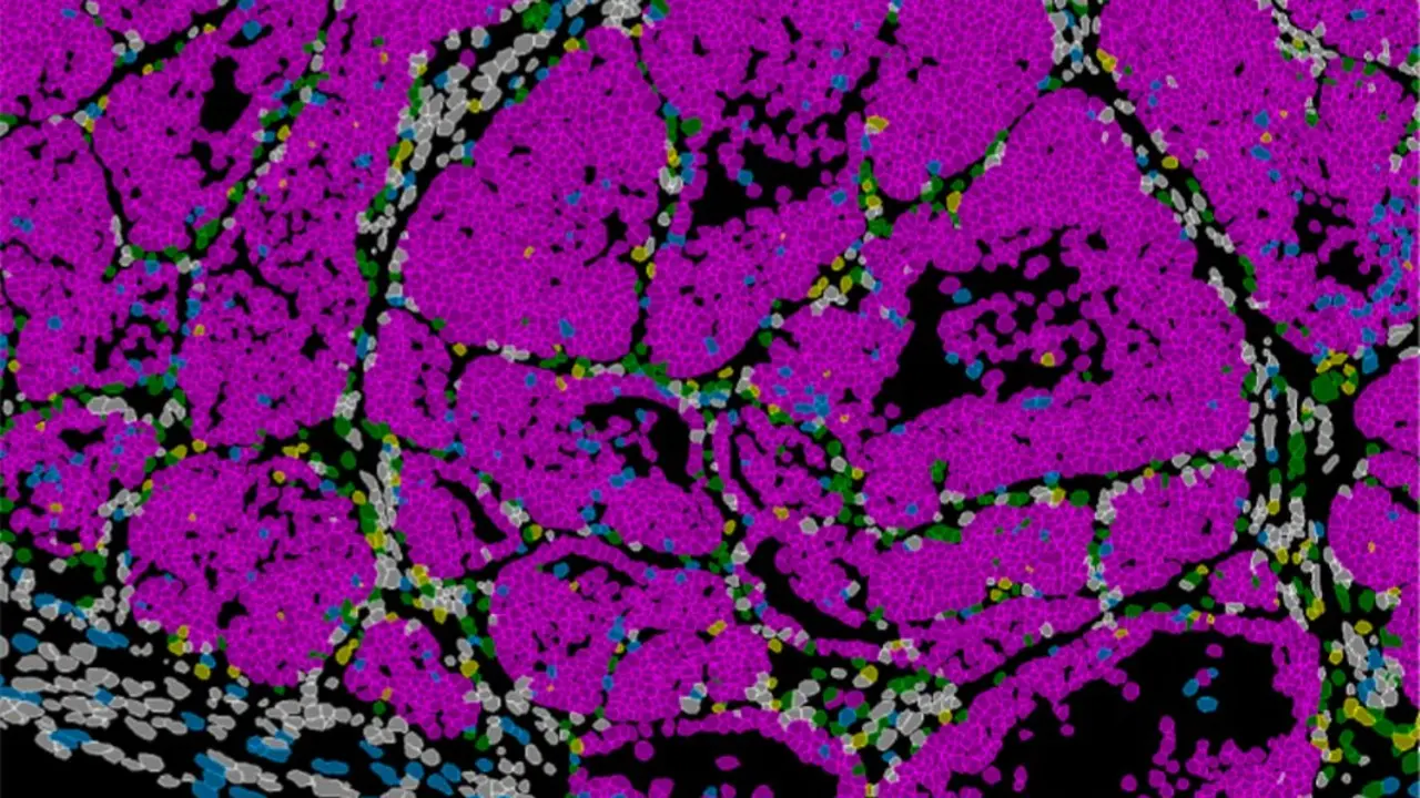 Tumor de mama en rat&oacute;n con c&eacute;lulas cancerosas (rosa). IN CSIC-UMH