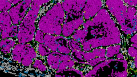Tumor de mama en rat&oacute;n con c&eacute;lulas cancerosas (rosa). IN CSIC-UMH