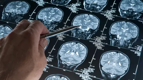 El diagn&oacute;stico de patolog&iacute;as degenerativas sigue bas&aacute;ndose en t&eacute;cnicas de hace m&aacute;s de 30 a&ntilde;os. / iStock