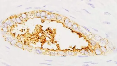 Expresi&oacute;n de la prote&iacute;na sAXL en tumores pancre&aacute;ticos. / IIBB-CSIC
