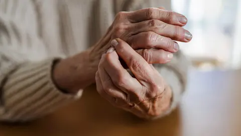 Manos de una persona con artritis reumatoide. / iStock