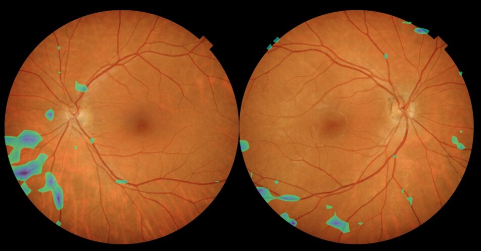 Retinografía - Foto de AItheroscope
